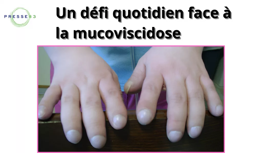 un défi quotidien face à la mucoviscidose.